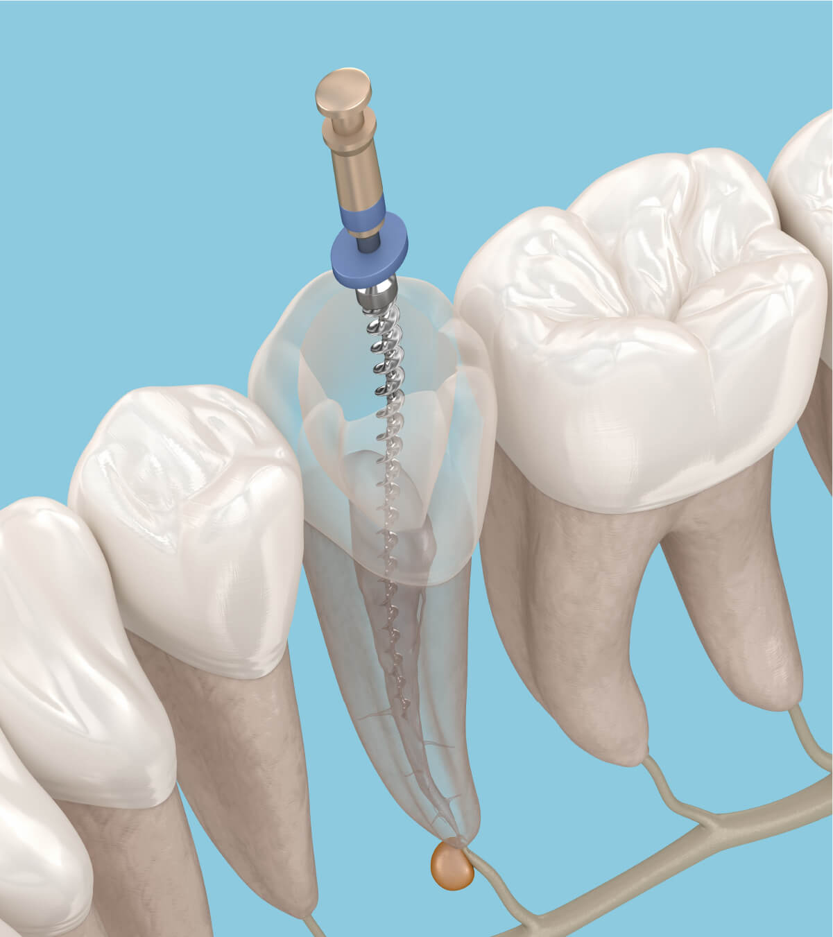 What Are Dental Crowns?